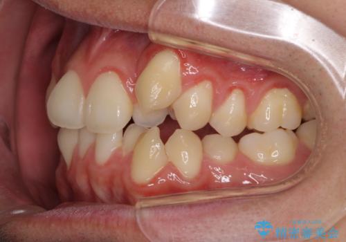 八重歯を治したい 目立たないワイヤー装置での抜歯矯正の治療前