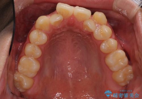 八重歯を治したい 目立たないワイヤー装置での抜歯矯正の治療前