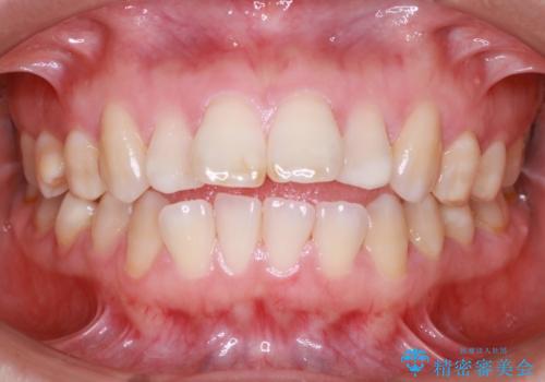 歯が前に出てて、口が閉じない　抜歯矯正による口元の改善の治療前