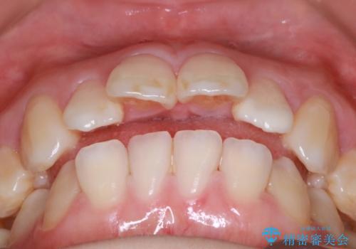 歯が前に出てて、口が閉じない 抜歯矯正による口元の改善の治療前