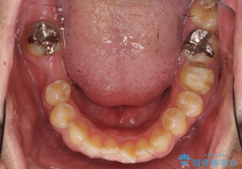初めてのインプラント 手術は怖いので、寝ている間に終わりたいの治療前