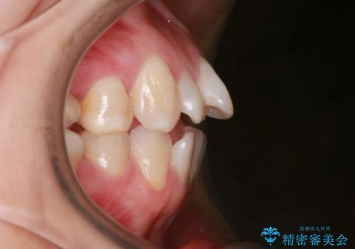 歯が前に出てて、口が閉じない 抜歯矯正による口元の改善の治療前