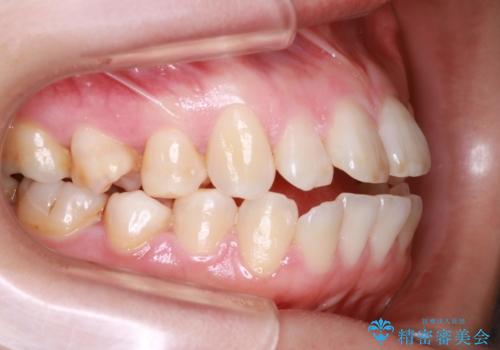 歯が前に出てて、口が閉じない　抜歯矯正による口元の改善の症例 治療前