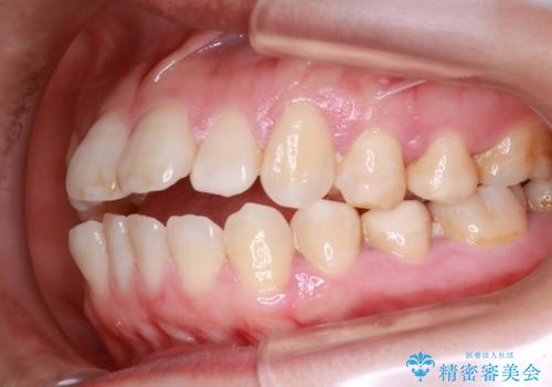 歯が前に出てて、口が閉じない 抜歯矯正による口元の改善の治療前