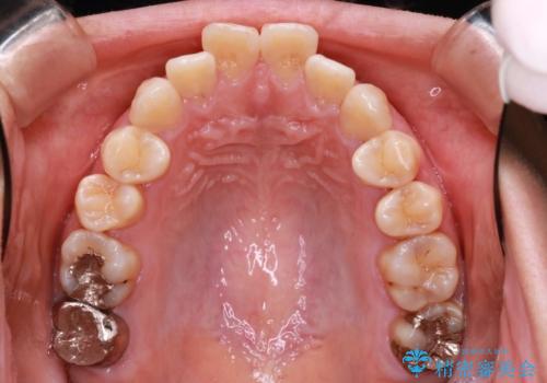歯が前に出てて、口が閉じない　抜歯矯正による口元の改善の治療前
