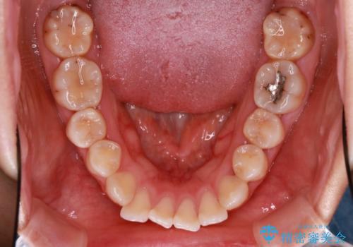 歯が前に出てて、口が閉じない 抜歯矯正による口元の改善の治療前