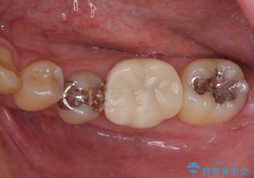 保険診療で装着した奥歯の白いクラウン　痛みが続くためセラミッククラウンへの症例 治療前