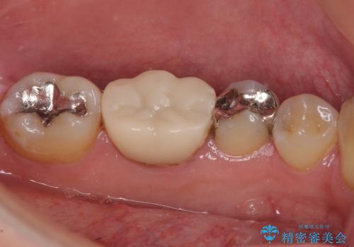 保険診療で装着した奥歯の白いクラウン 痛みが続くためセラミッククラウンへの治療前
