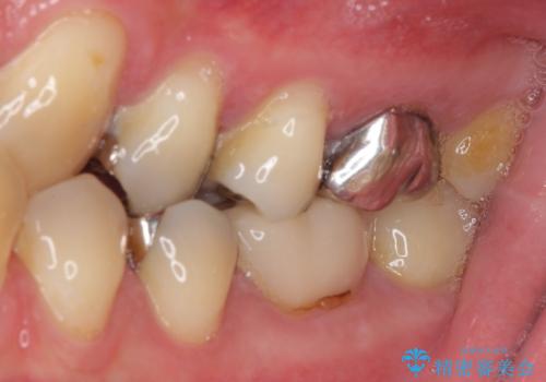 保険診療で装着した奥歯の白いクラウン 痛みが続くためセラミッククラウンへの治療前