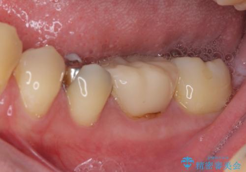 保険診療で装着した奥歯の白いクラウン　痛みが続くためセラミッククラウンへの治療前