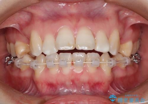 歯が前に出てて、口が閉じない　抜歯矯正による口元の改善の治療中