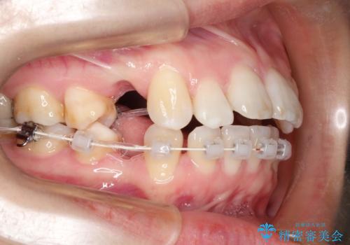 歯が前に出てて、口が閉じない 抜歯矯正による口元の改善の治療中