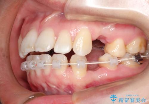 歯が前に出てて、口が閉じない 抜歯矯正による口元の改善の治療中