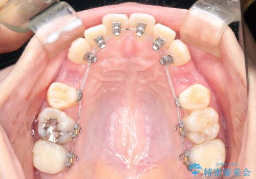 歯が前に出てて、口が閉じない 抜歯矯正による口元の改善の治療中