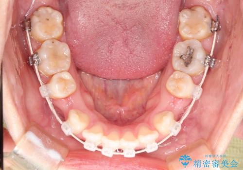 歯が前に出てて、口が閉じない　抜歯矯正による口元の改善の治療中