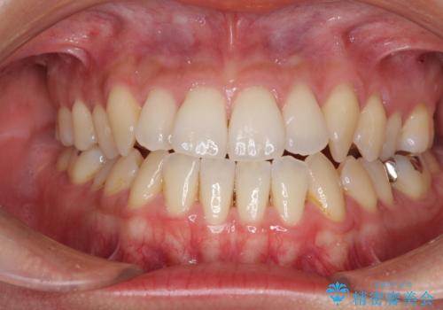 前歯のデコボコ インビザラインによる矯正治療の症例 治療前