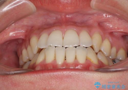 前歯のデコボコ インビザラインによる矯正治療の治療前