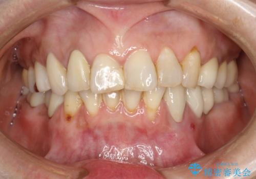 PMTCで歯を綺麗にの治療前
