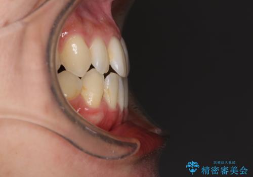 前歯のデコボコ インビザラインによる矯正治療の治療前