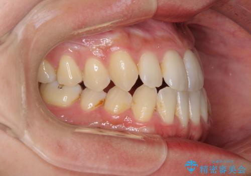 前歯のデコボコ　インビザラインによる矯正治療の治療前