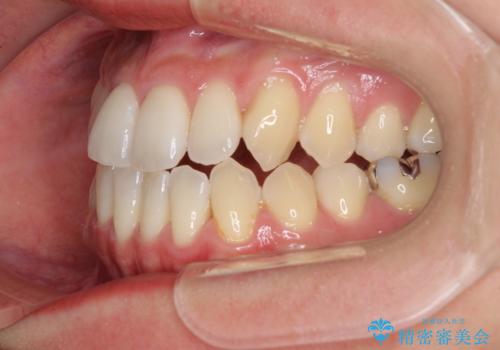 前歯のデコボコ インビザラインによる矯正治療の治療前