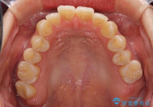 前歯のデコボコ インビザラインによる矯正治療の治療前