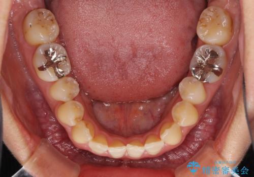 前歯のデコボコ　インビザラインによる矯正治療の治療前