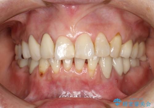 PMTCで歯を綺麗にの治療後