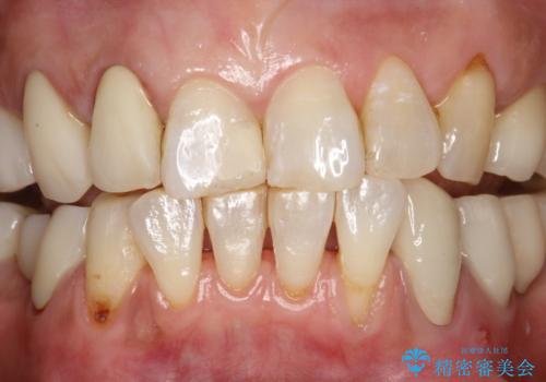 PMTCで歯を綺麗に