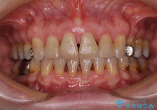 閉じにくい口元を改善したい　ワイヤー装置での抜歯矯正の症例 治療後