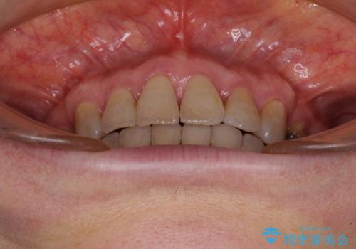 閉じにくい口元を改善したい ワイヤー装置での抜歯矯正の治療後