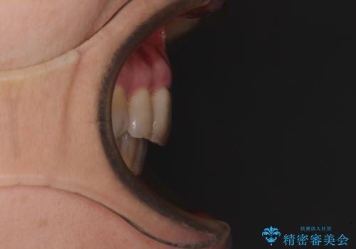 閉じにくい口元を改善したい ワイヤー装置での抜歯矯正の治療後