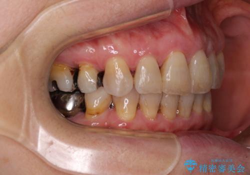 閉じにくい口元を改善したい　ワイヤー装置での抜歯矯正の治療後
