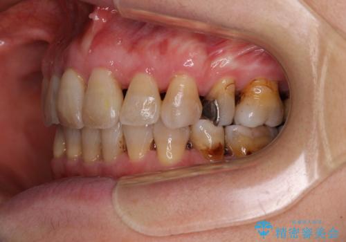 閉じにくい口元を改善したい ワイヤー装置での抜歯矯正の治療後