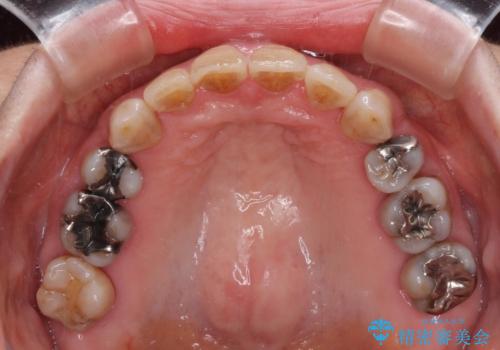 閉じにくい口元を改善したい　ワイヤー装置での抜歯矯正の治療後