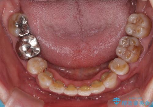 閉じにくい口元を改善したい ワイヤー装置での抜歯矯正の治療後