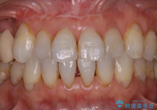 歯のクリーニングPMTC60分コースの治療前