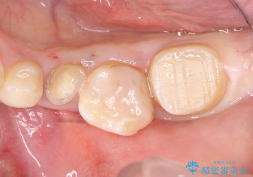 オールセラミッククラウン　歯の挺出・歯周外科による歯茎より深い虫歯の治療の治療前