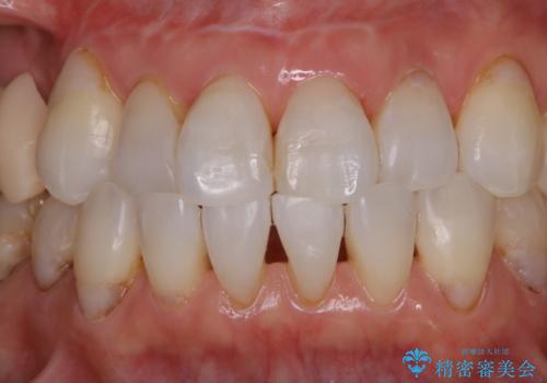 歯のクリーニングPMTC60分コースの治療後
