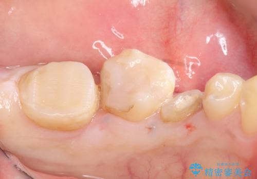 オールセラミッククラウン 歯の挺出・歯周外科による歯茎より深い虫歯の治療の治療前