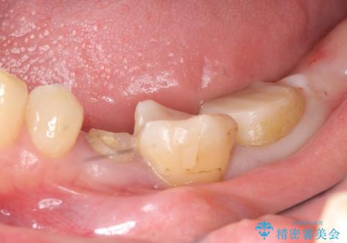 オールセラミッククラウン 歯の挺出・歯周外科による歯茎より深い虫歯の治療の治療前