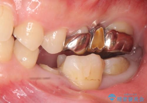 オールセラミッククラウン　歯の挺出・歯周外科による歯茎より深い虫歯の治療の治療前