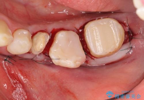オールセラミッククラウン 歯の挺出・歯周外科による歯茎より深い虫歯の治療の治療後