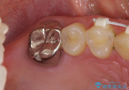 隙間だらけの歯列をきれいに インビザライン矯正とセラミック補綴治療の治療中