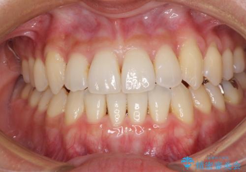 前歯のデコボコ インビザラインによる矯正治療の治療中