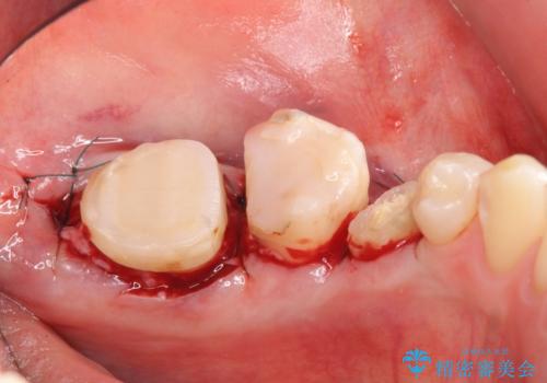 オールセラミッククラウン 歯の挺出・歯周外科による歯茎より深い虫歯の治療の治療後