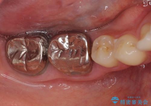 隙間だらけの歯列をきれいに インビザライン矯正とセラミック補綴治療の治療中