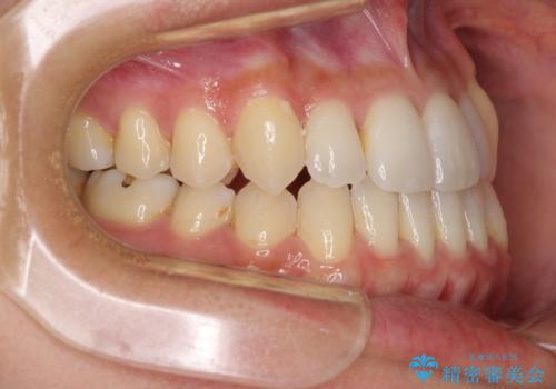 前歯のデコボコ　インビザラインによる矯正治療の治療中