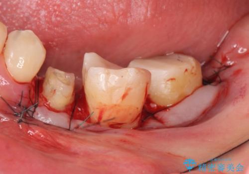 オールセラミッククラウン 歯の挺出・歯周外科による歯茎より深い虫歯の治療の治療後