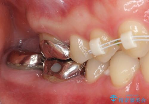 隙間だらけの歯列をきれいに インビザライン矯正とセラミック補綴治療の治療中